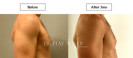 Male Breast Reduction Surgery with Dr. Itay Wiser