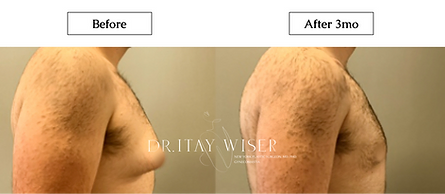 Male Breast Reduction Surgery with Dr. Itay Wiser