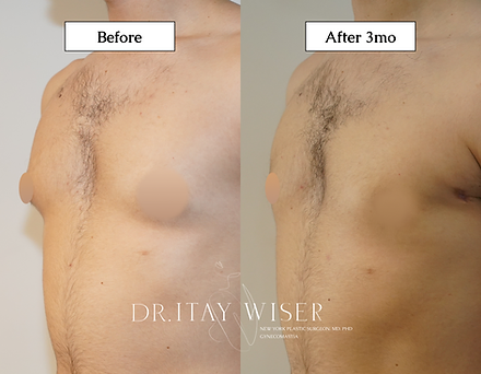 Male Breast Reduction Surgery with Dr. Itay Wiser